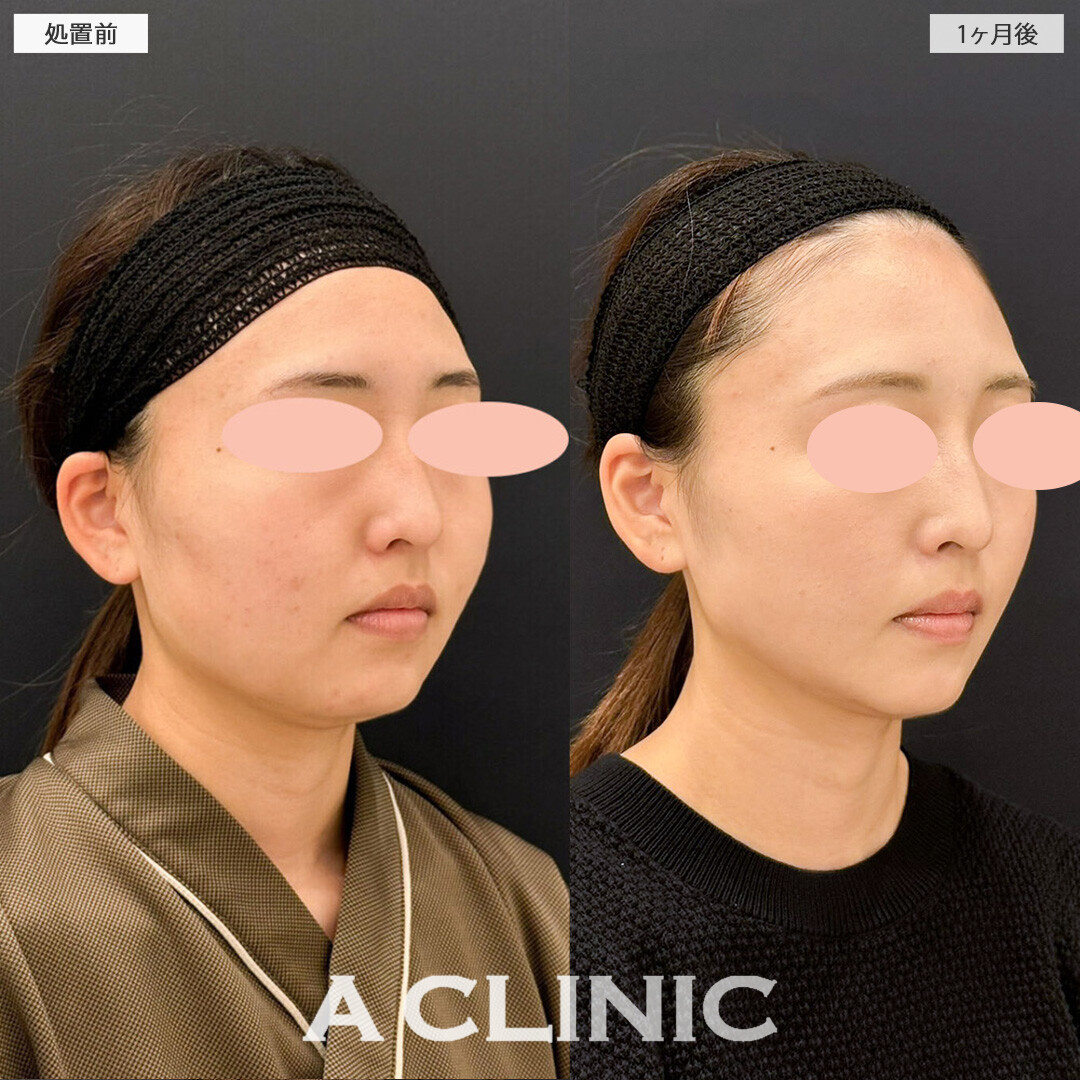 1day小顔脂肪吸引と小顔エラボトックスでスッキリ小顔になりました！こちら処置前と3ヶ月後の症例です(20代女性)