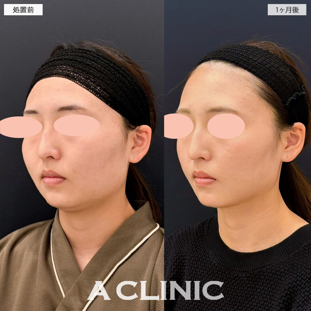 1day小顔脂肪吸引と小顔エラボトックスでスッキリ小顔になりました！こちら処置前と3ヶ月後の症例です(20代女性)