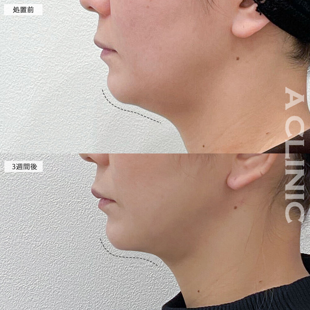 1day小顔脂肪吸引でお顔のたるみがなくなり若返りました！こちら処置前から3週間後の症例です。(40代女性)