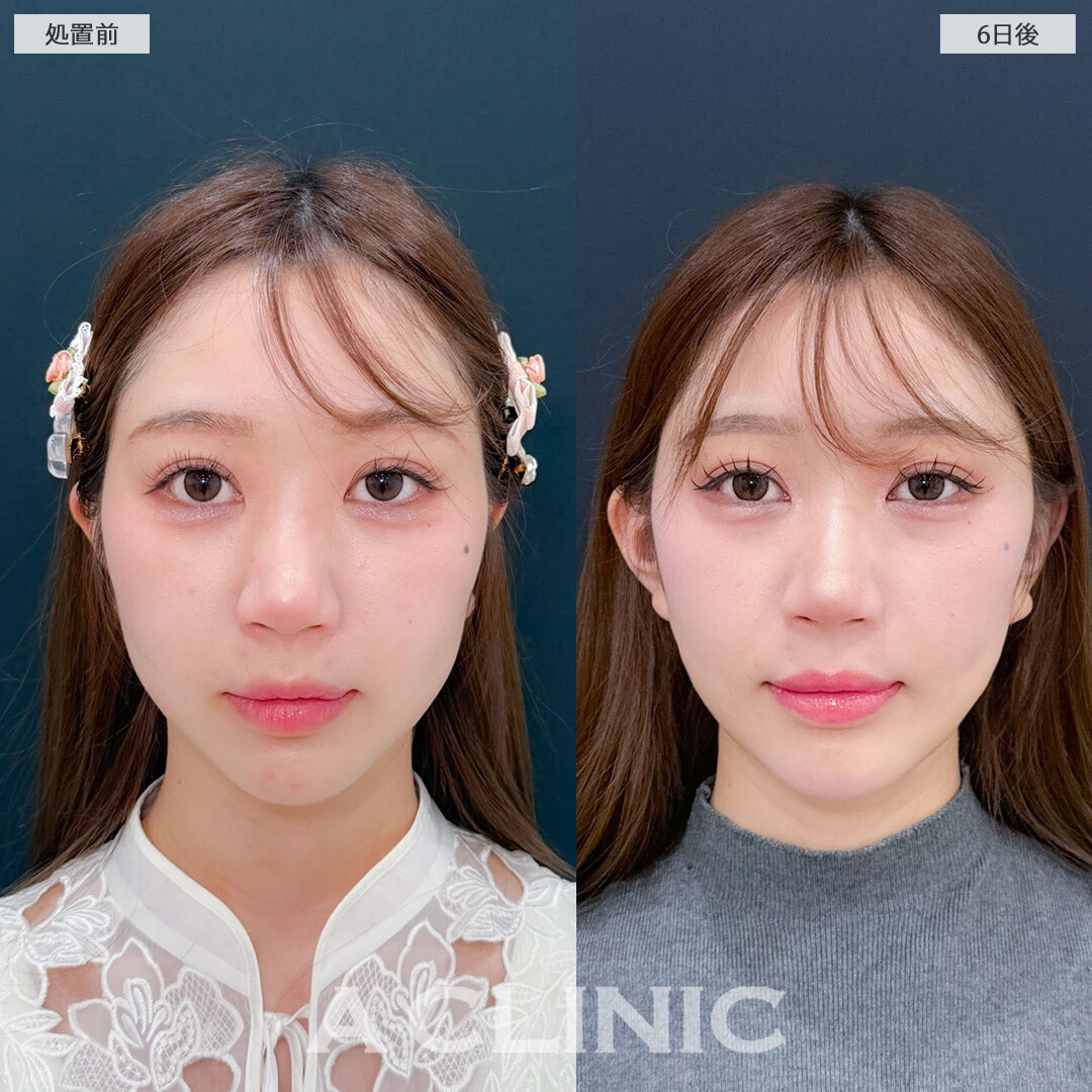 1day小顔脂肪吸引と立ち耳ヒアルロン酸注入(ボリューマ)でワンホン小顔美女に！こちら処置前と6日後の症例です(20代女性)