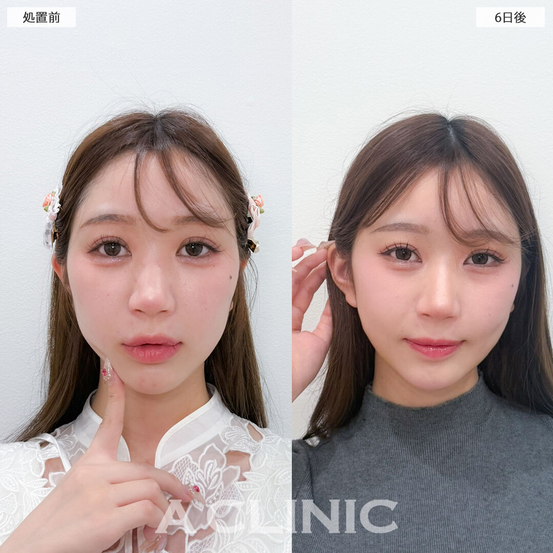 1day小顔脂肪吸引と立ち耳ヒアルロン酸注入(ボリューマ)でワンホン小顔美女に！こちら処置前と6日後の症例です(20代女性)