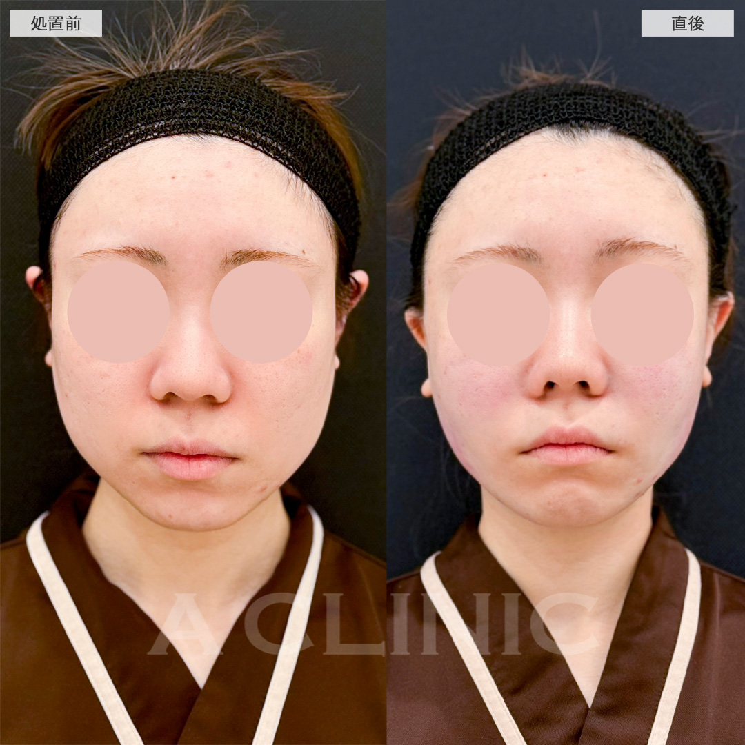 1day小顔脂肪吸引で頬の肉感が減ってフェイスラインがスッキリしました！処置から1ヶ月後の症例です(20代女性)