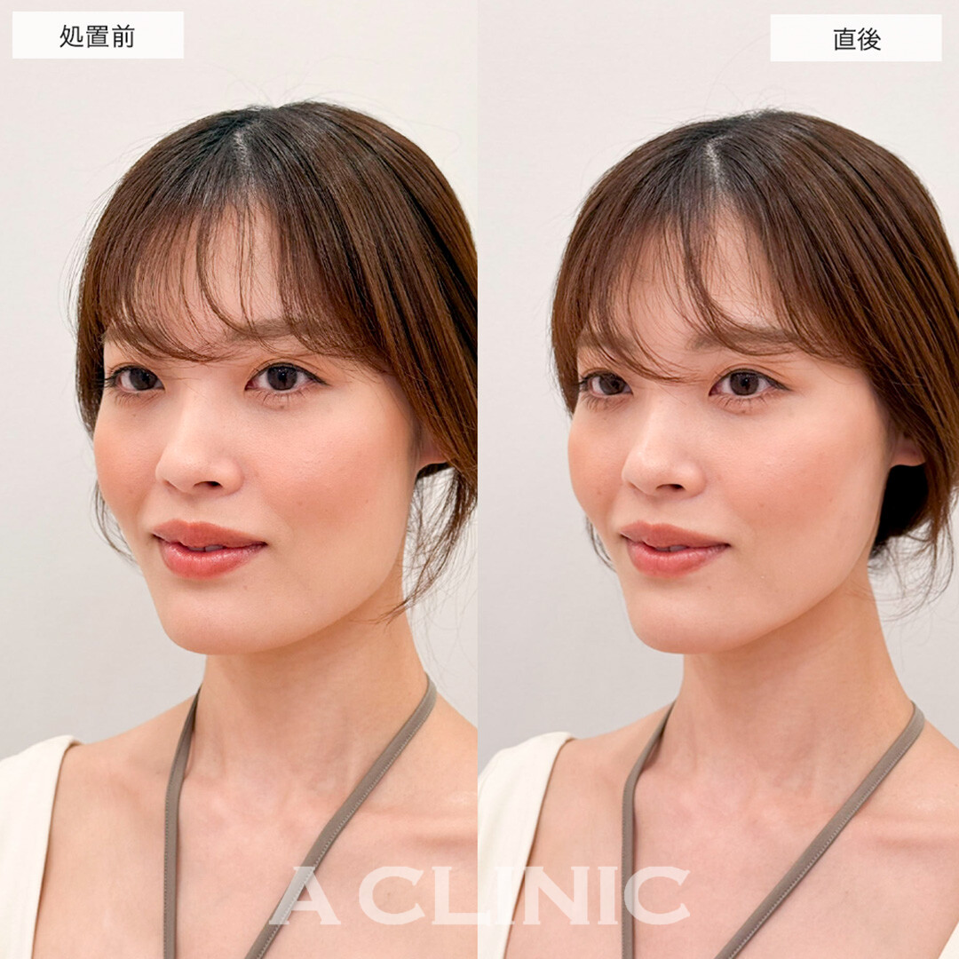 Aスレッドでたるみが改善され美しい滑らかな輪郭に!こちら処置前と直後の症例です(30代女性)