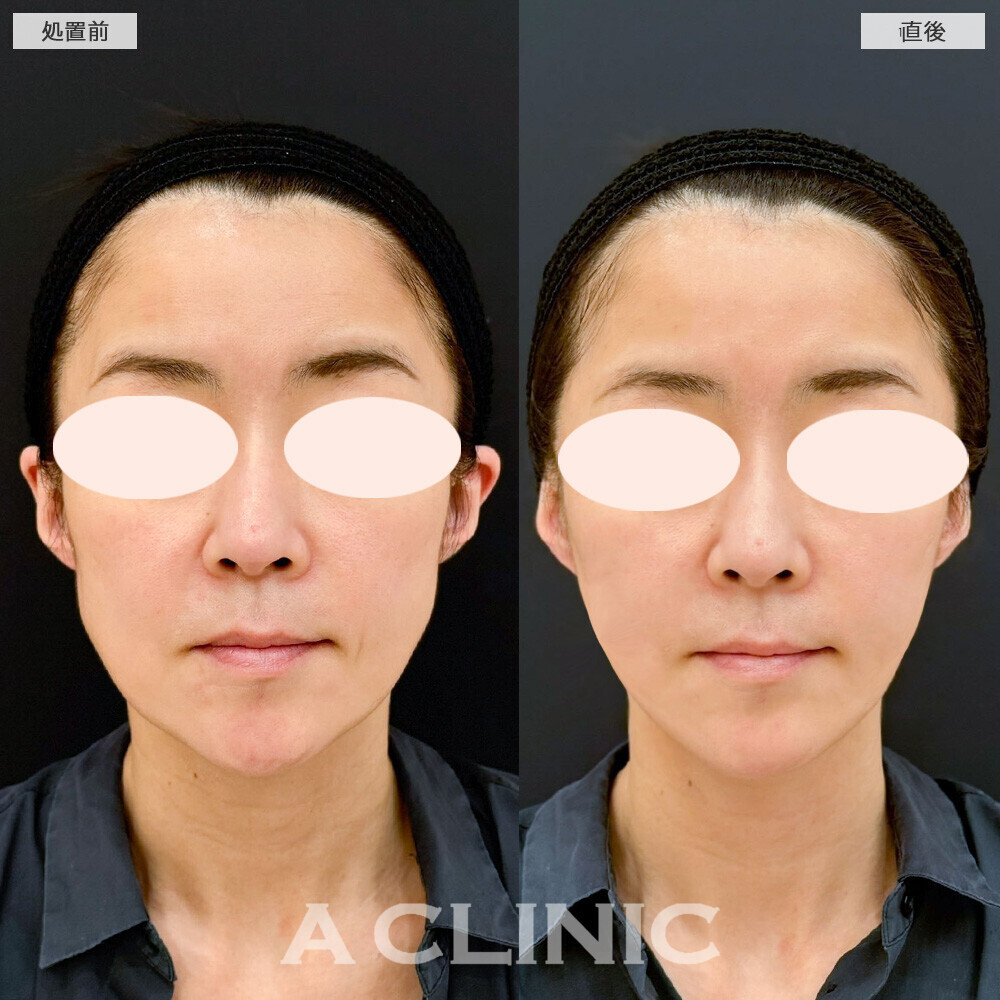 Aスレッドでフェイスラインの形が整いました！こちら処置前と直後の症例です。(40代女性)
