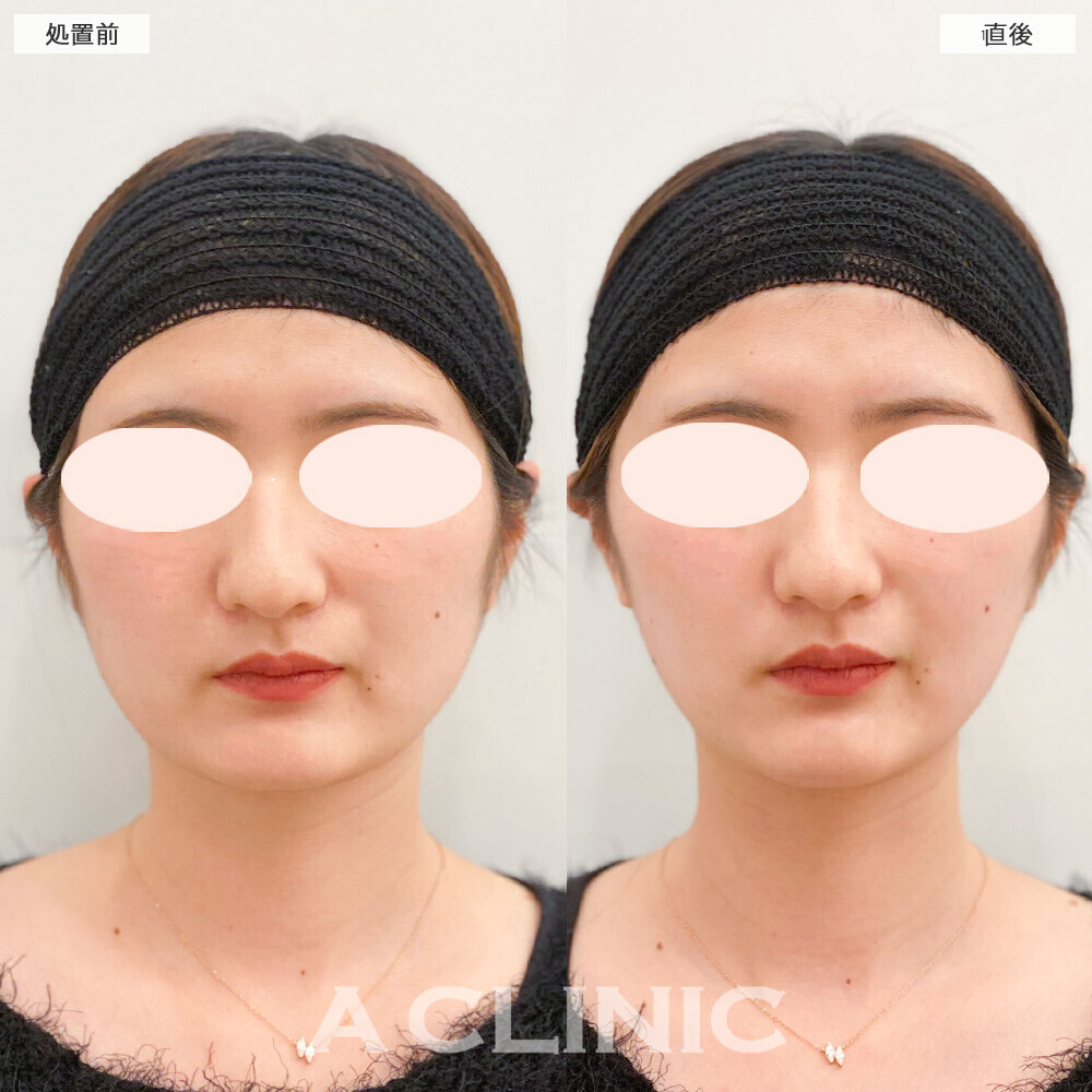 Aスレッドで顔の下に溜まったたるみがスッキリリフトアップ！こちら処置前と直後の症例です。(20代)