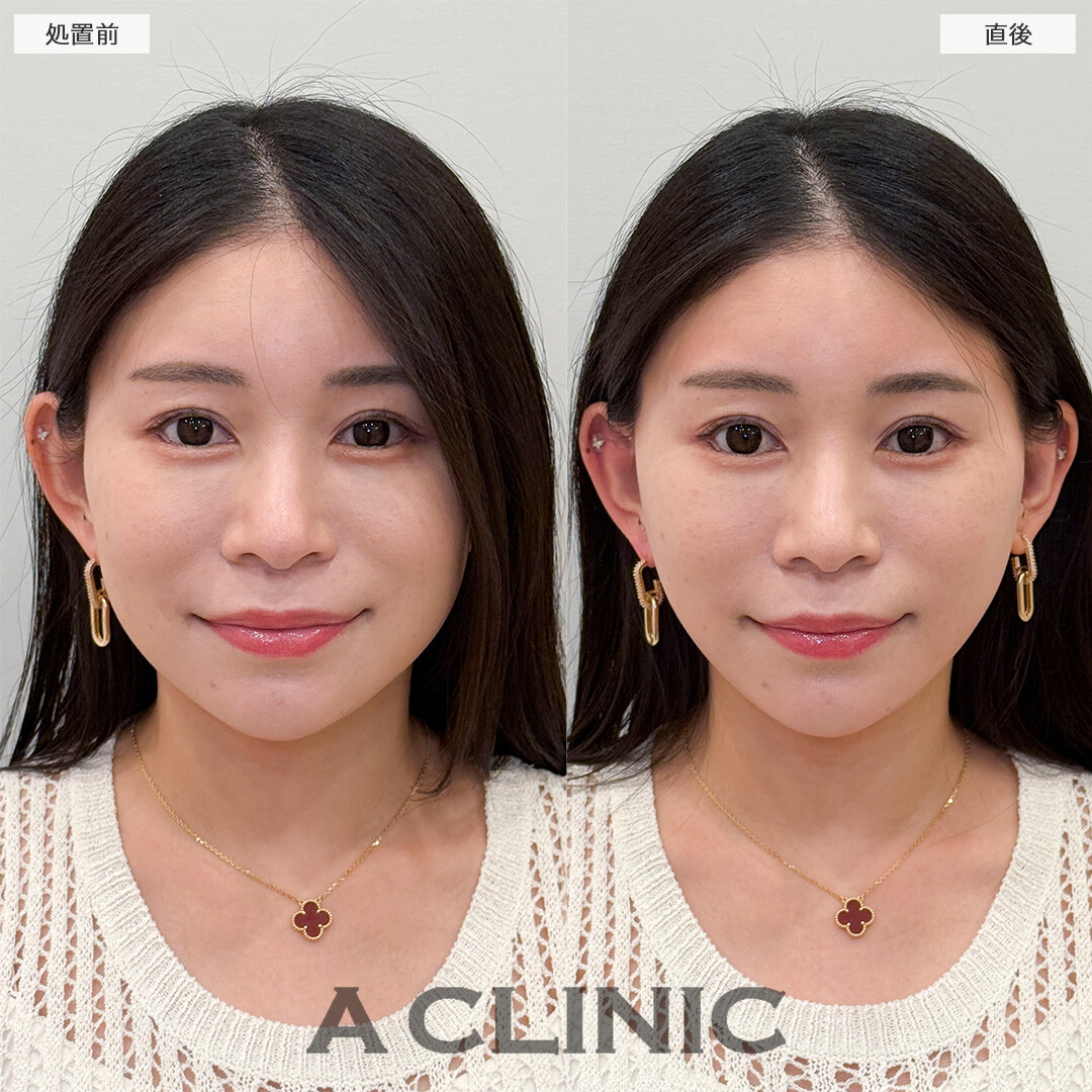 Aスレッドで中顔面短縮効果も得られます！処置前と直後の症例です(30代女性)