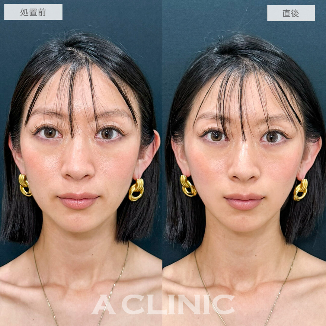 Aスレッドでほうれい線と口横のもたつき感が解消しました！処置前と直後の症例です(30代女性)