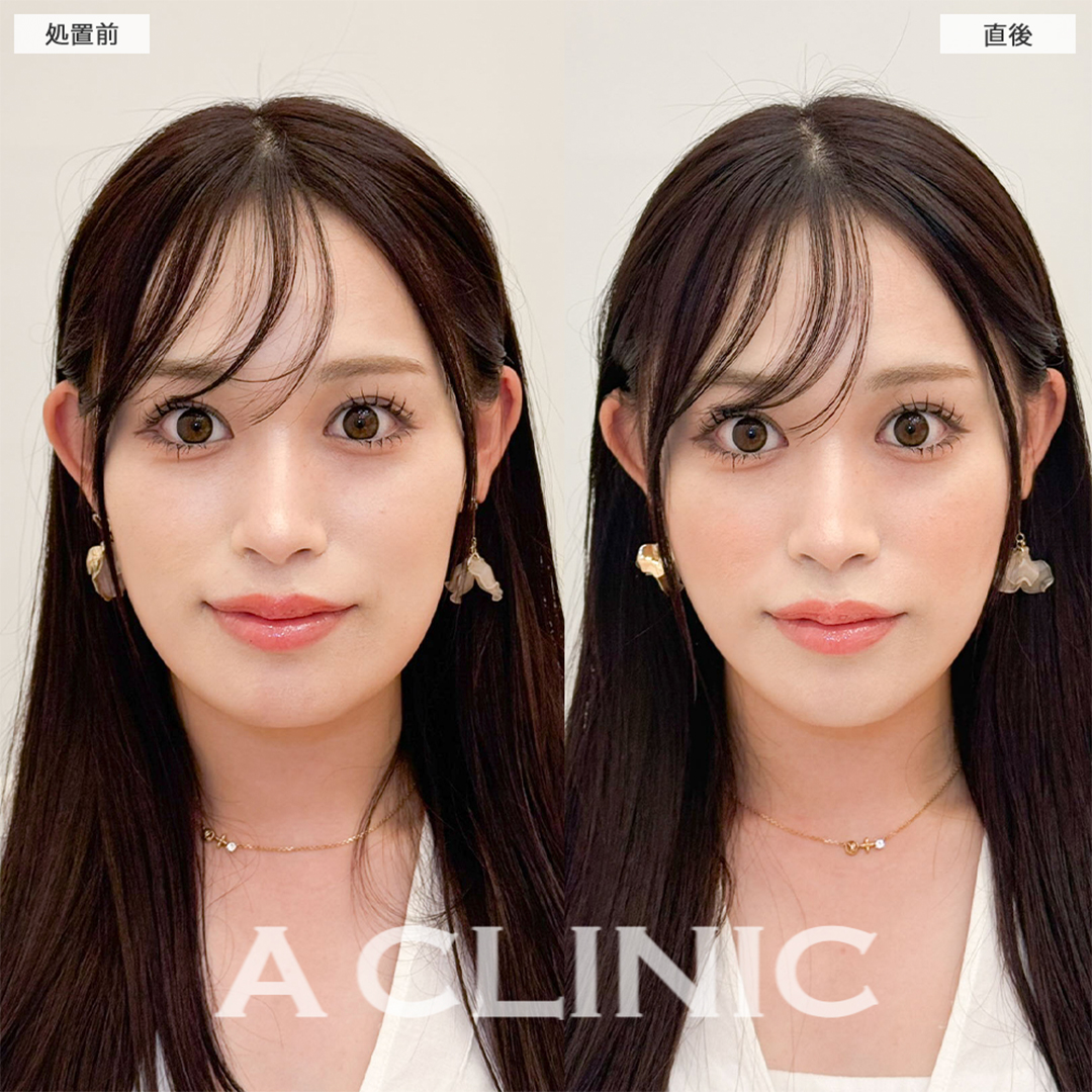 Aスレッドで左右差が無くなりナチュラルにリフトアップ成功！処置前と直後の症例です(20代女性)