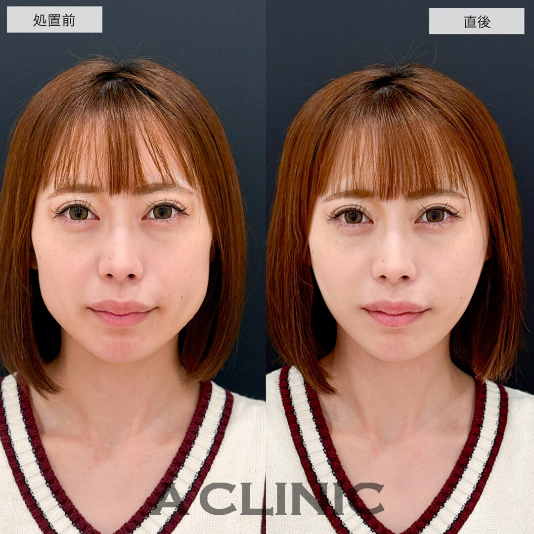 Aスレッドでたるみを引き上げて若々しい綺麗な輪郭に!こちら処置前と直後の症例です(30代女性)