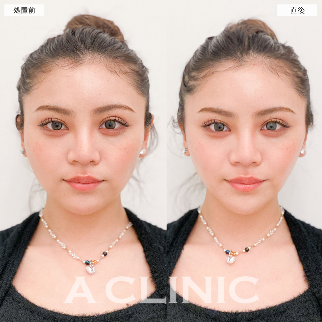 Aスレッドで韓国アイドルのような逆三角形の輪郭に大変身！こちら処置前と直後の症例です(20代女性)
