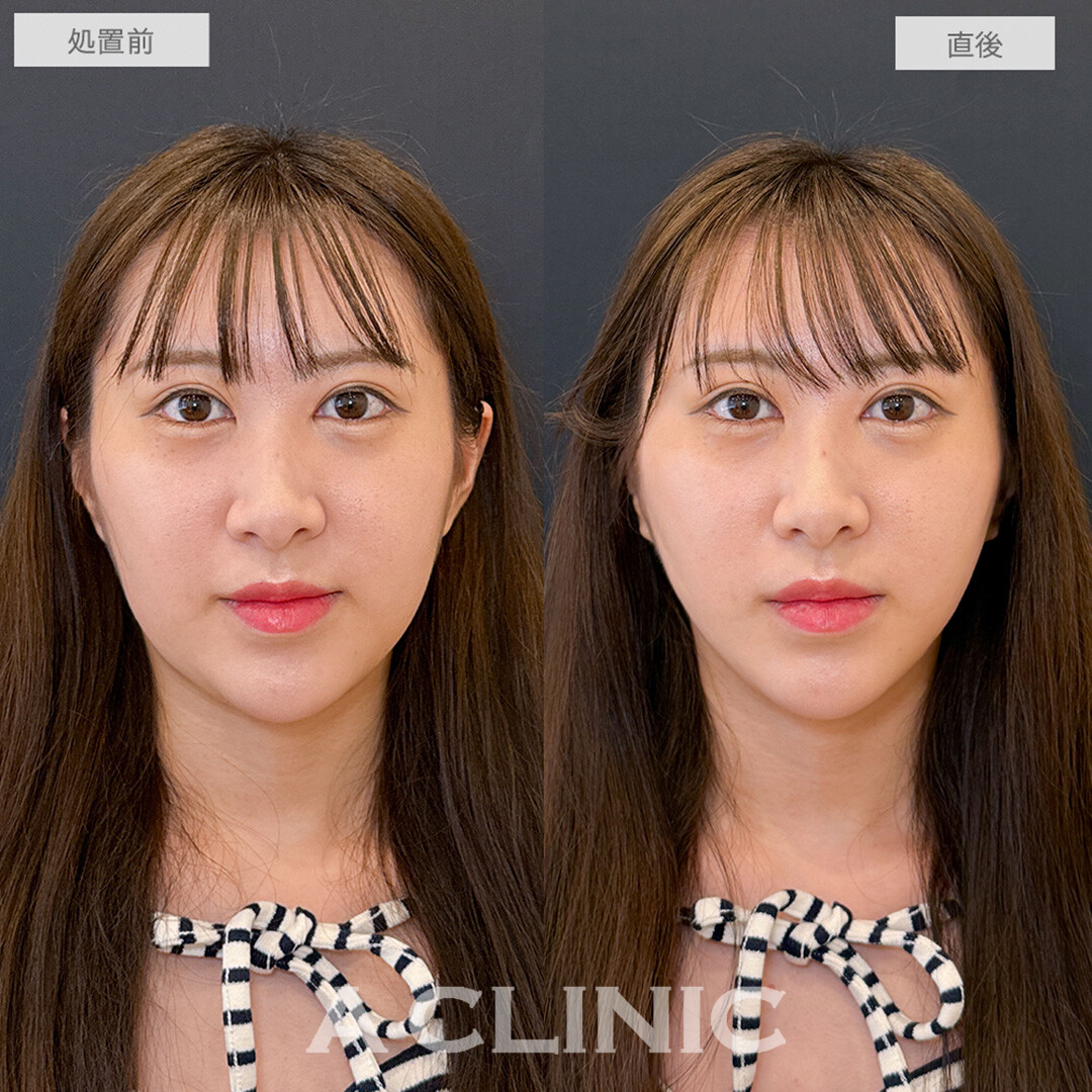 Aスレッドでたるみを強力リフトアップ！こちら処置前と直後の症例です(20代女性)