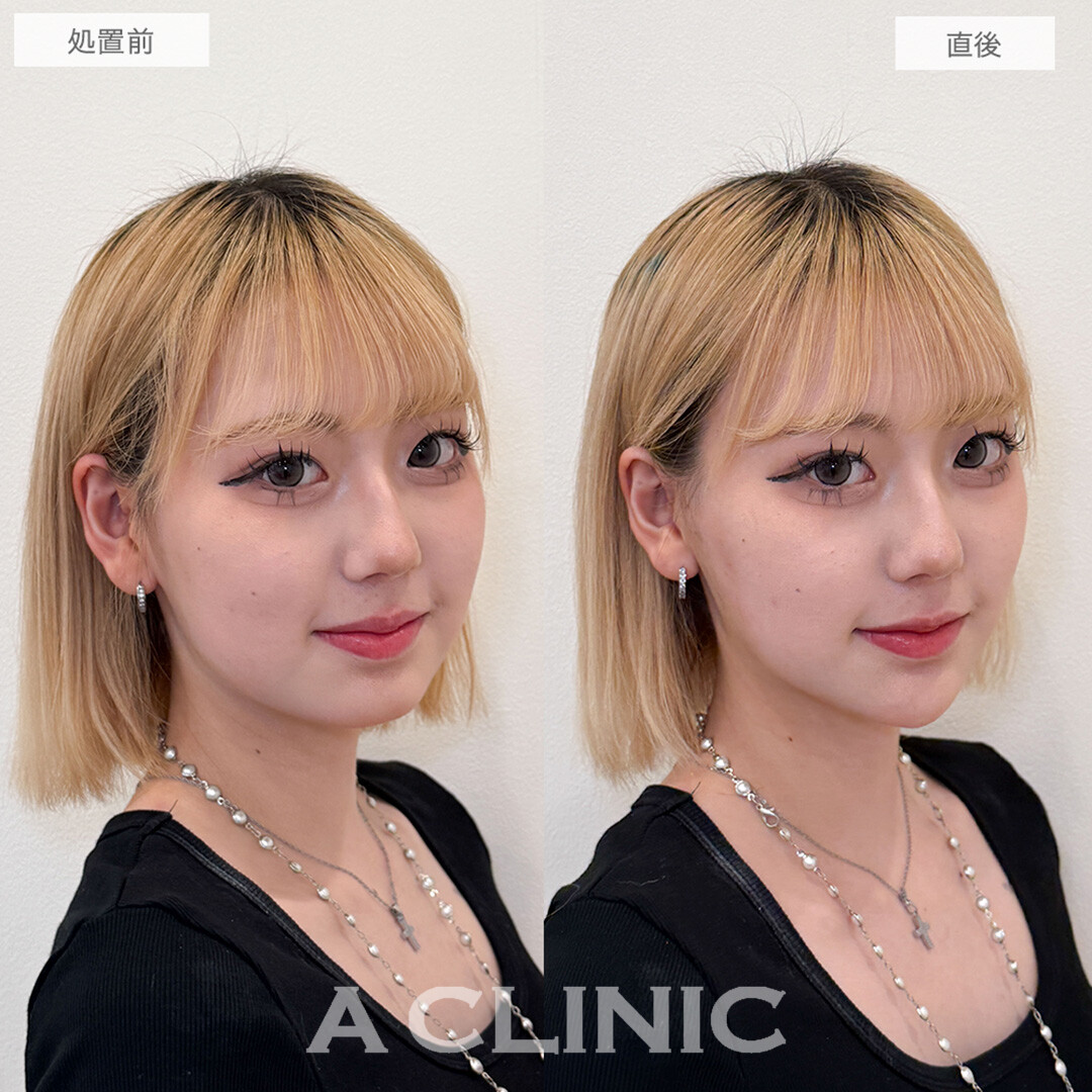 Aスレッドとあごへのヒアルロン酸注入で憧れのVフェイスに！こちら処置前と直後の症例です(20代女性)