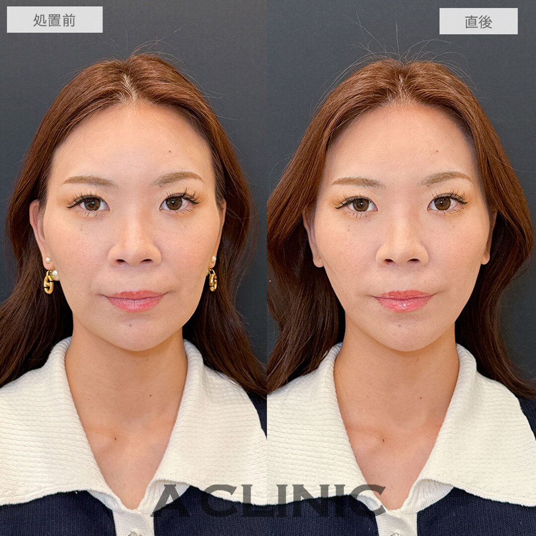 Aスレッドのリフトアップで老け見え回避！こちら処置前と直後の症例です(30代女性)