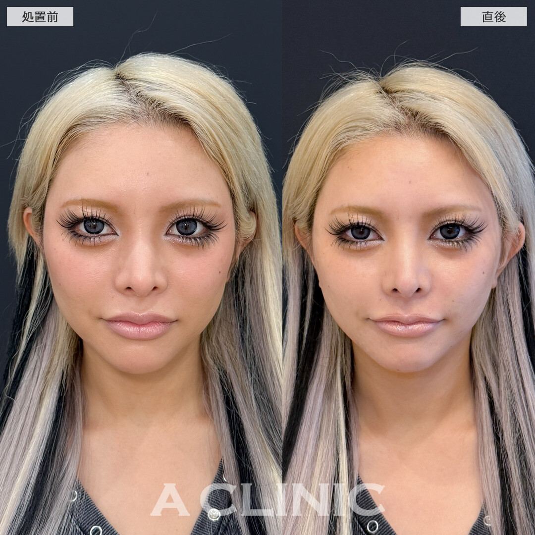 Aスレッドの小顔効果で圧倒的に写真が盛れるようになりました！処置前と直後の症例です(30代女性)