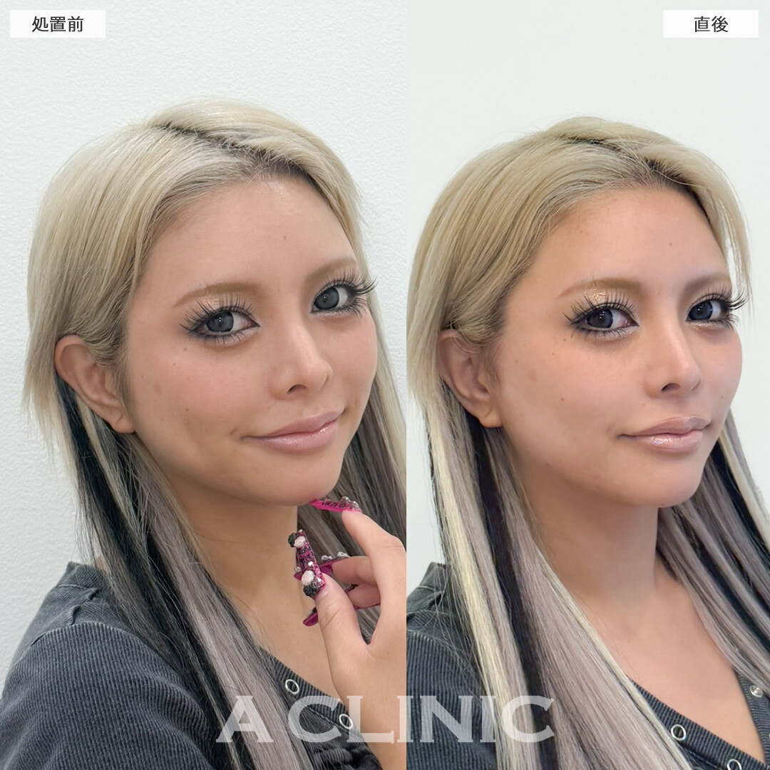 Aスレッドの小顔効果で圧倒的に写真が盛れるようになりました！処置前と直後の症例です(30代女性)