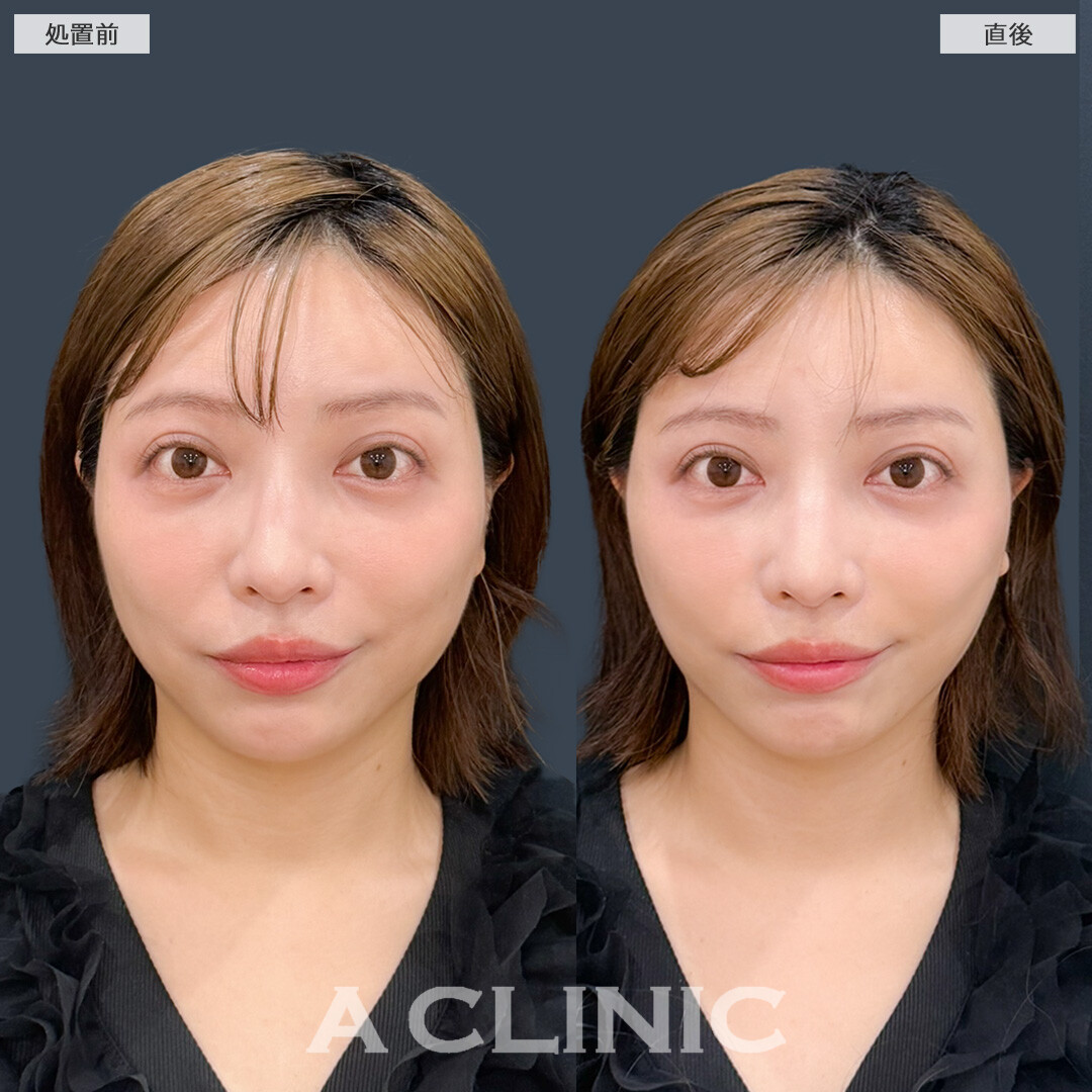 Aスレッドでたるみにくいフェイスを目指せます！処置前と直後の症例です(30代女性)