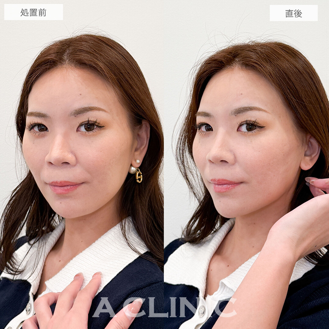 Aスレッドのリフトアップで老け見え回避！こちら処置前と直後の症例です(30代女性)