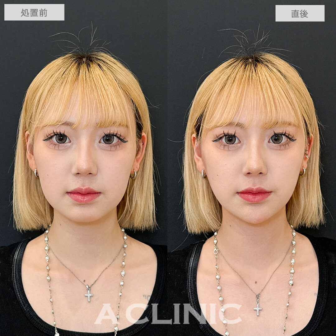 Aスレッドとあごへのヒアルロン酸注入で憧れのVフェイスに！こちら処置前と直後の症例です(20代女性)