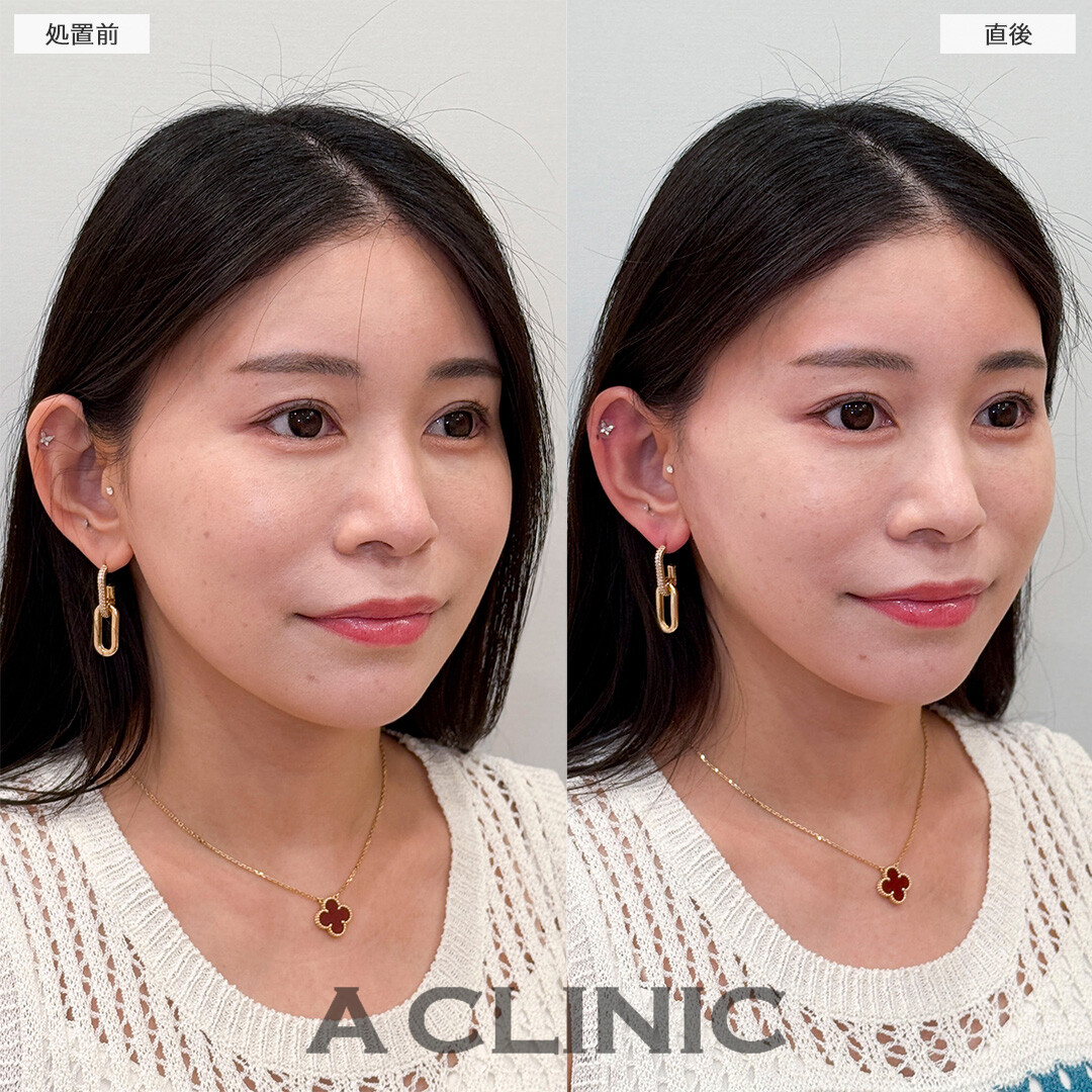 Aスレッドで中顔面短縮効果も得られます！処置前と直後の症例です(30代女性)