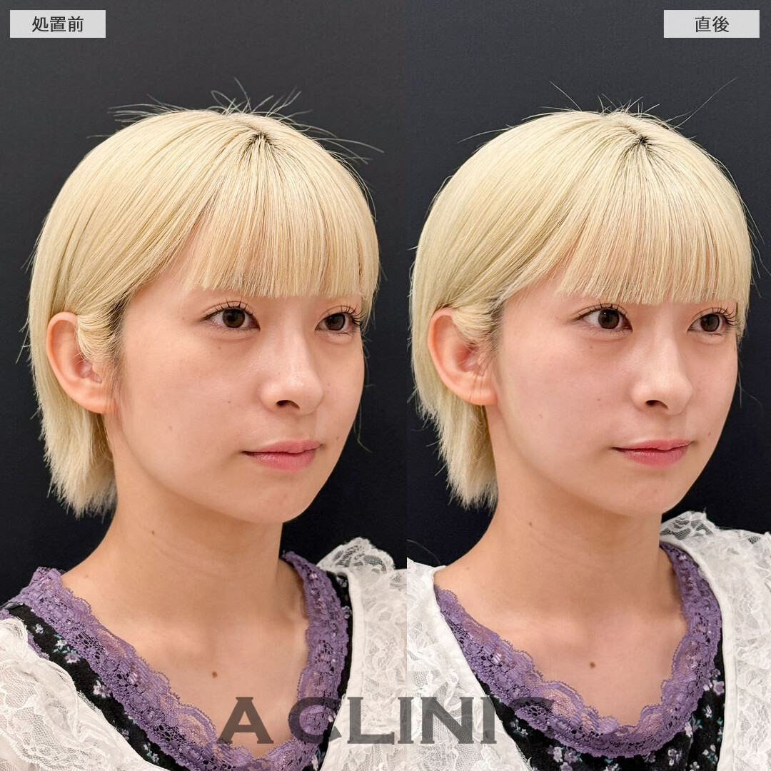 Aスレッドの定期的なメンテナンスで小顔キープが叶います！こちら処置前と直後の症例です(20代女性)