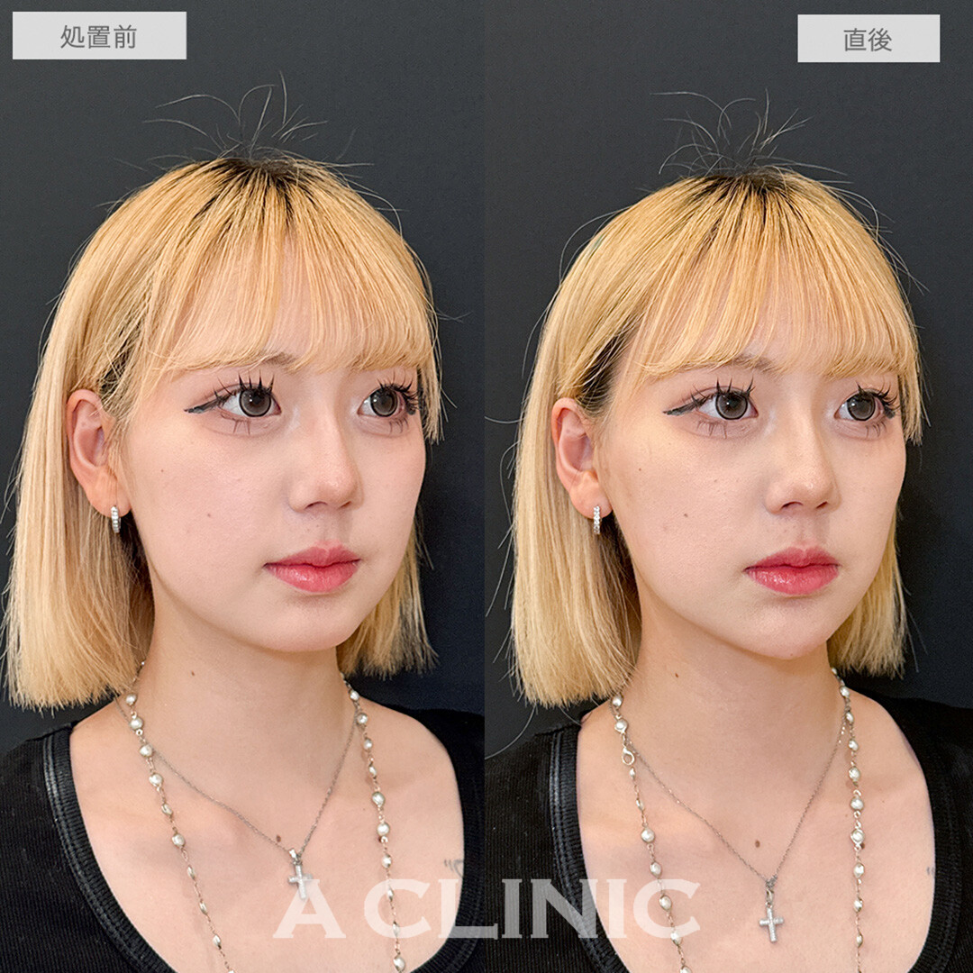 Aスレッドとあごへのヒアルロン酸注入で憧れのVフェイスに！こちら処置前と直後の症例です(20代女性)