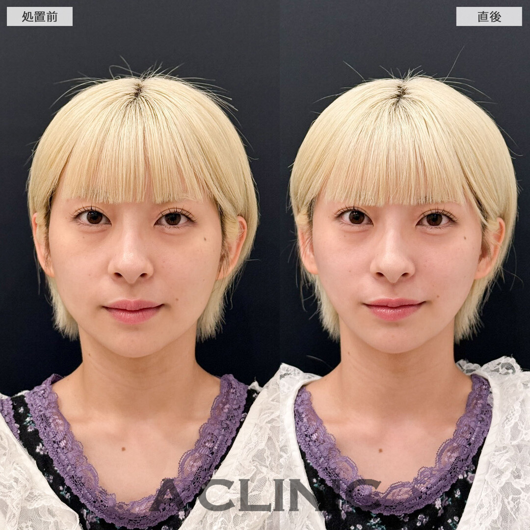 Aスレッドの定期的なメンテナンスで小顔キープが叶います！こちら処置前と直後の症例です(20代女性)