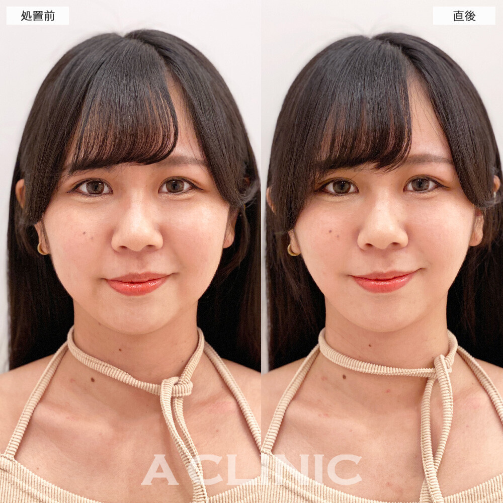 Aスレッドで頬の丸みがシュッとしました！こちら処置前と直後の症例です(20代女性)