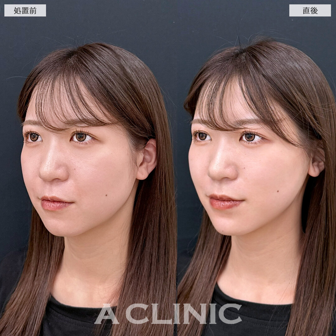 Aスレッドで直後からスッキリした輪郭になって垢抜け！こちら処置前と直後の症例です(20代女性)
