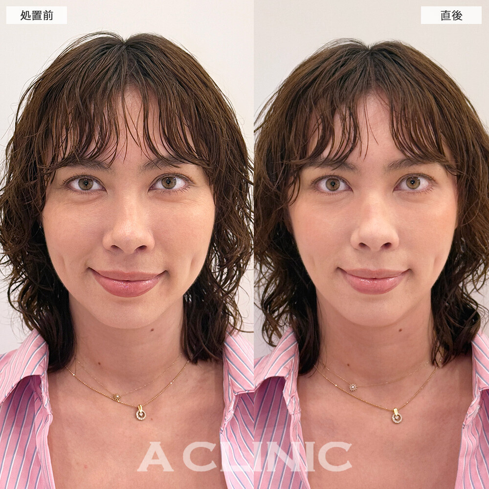 Aスレッドで全体的にリフトアップしました！こちら処置前と直後の症例です(30代女性)