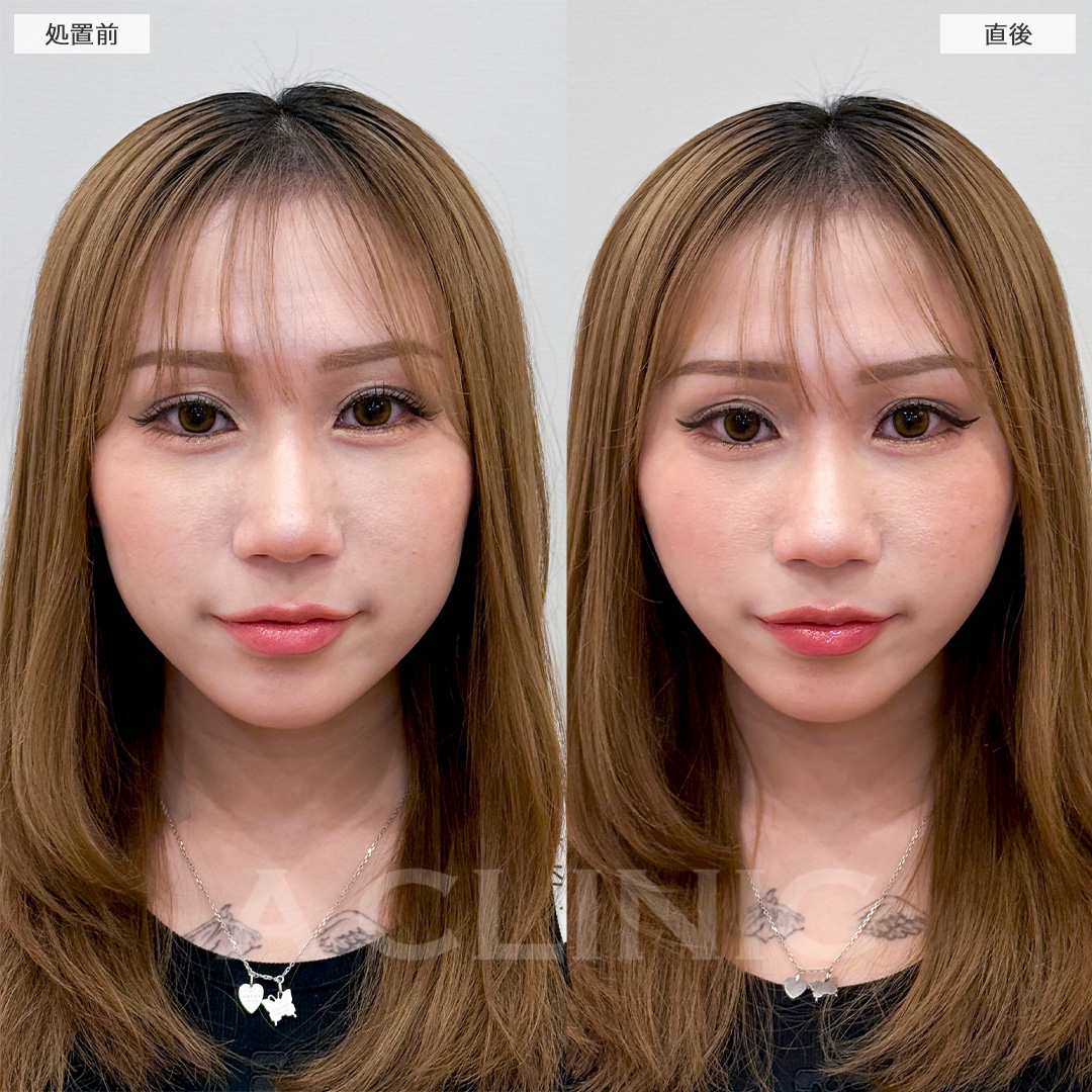 Aスレッドでホームベース型の輪郭がV字型に！処置前と直後の症例です(20代女性)