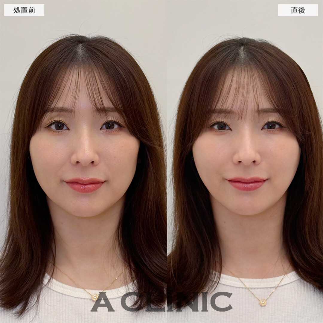 Aスレッドは老け予防でも大人気です！こちら処置前と直後の症例です(30代女性)