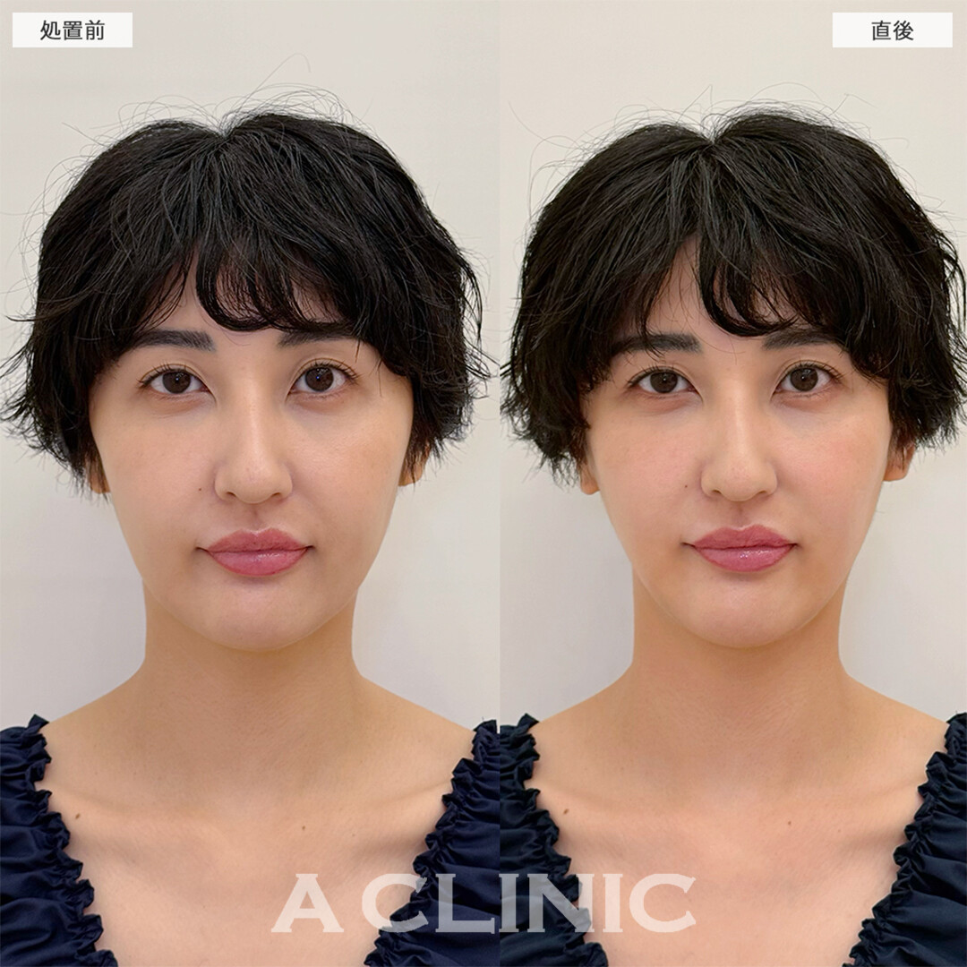 Aスレッドで初めての整形大成功！こちら処置前と直後の症例です(30代女性)
