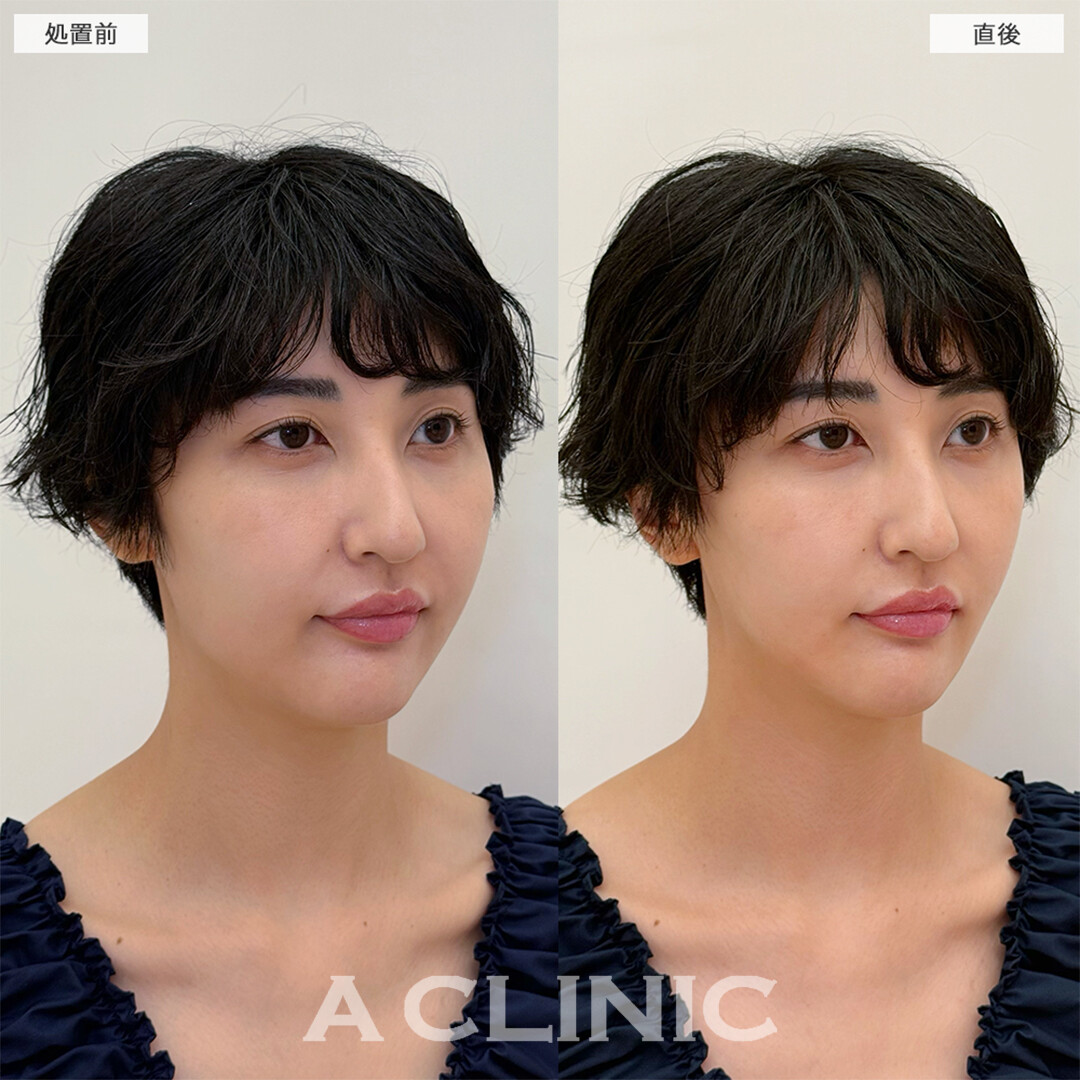 Aスレッドで初めての整形大成功！こちら処置前と直後の症例です(30代女性)