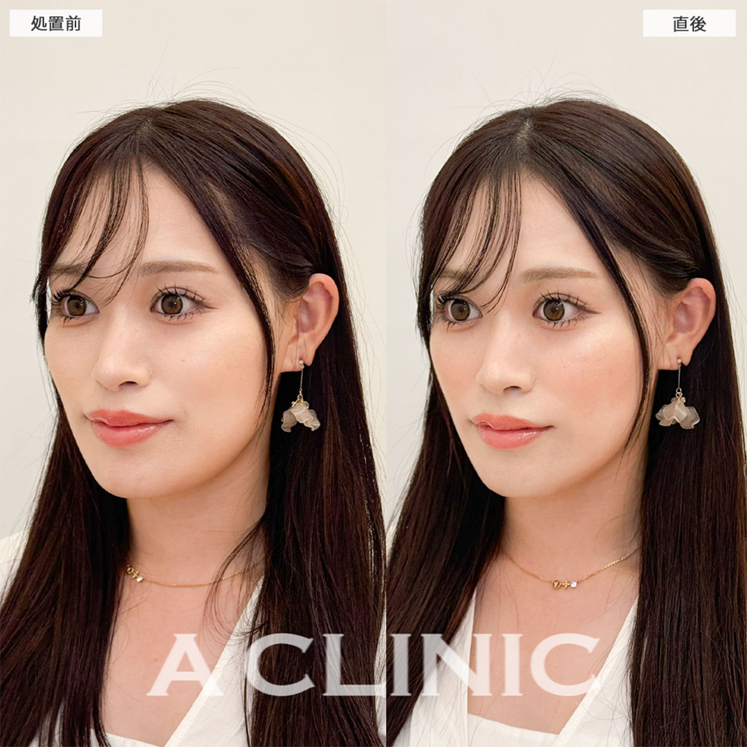 Aスレッドで左右差が無くなりナチュラルにリフトアップ成功！処置前と直後の症例です(20代女性)
