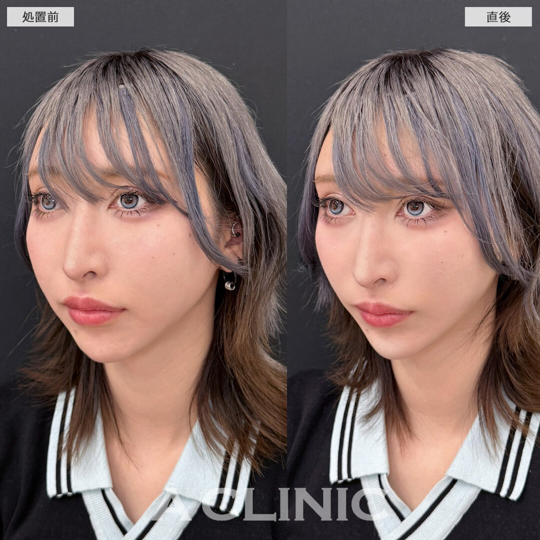 ほうれい線が解消され加工後のようなVフェイスに！Aスレッドの処置前と直後の症例です(30代女性)
