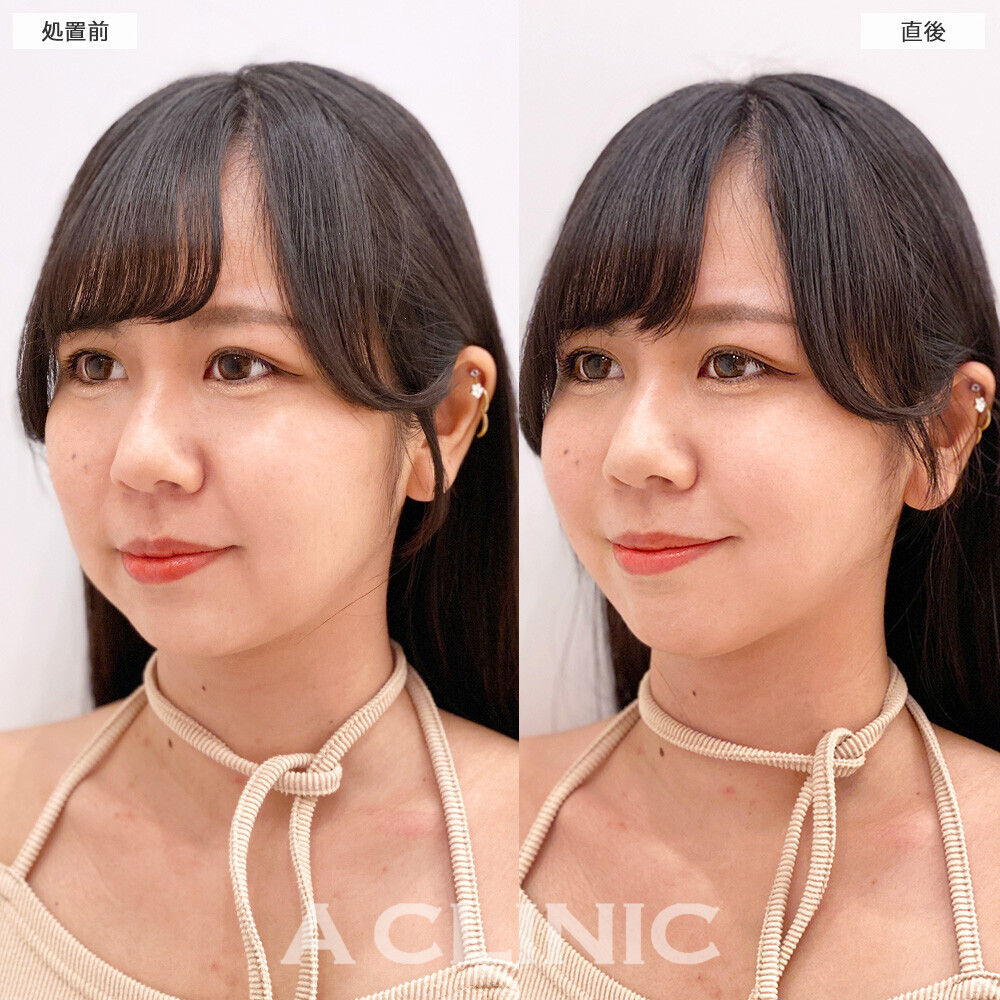 Aスレッドで頬の丸みがシュッとしました！こちら処置前と直後の症例です(20代女性)