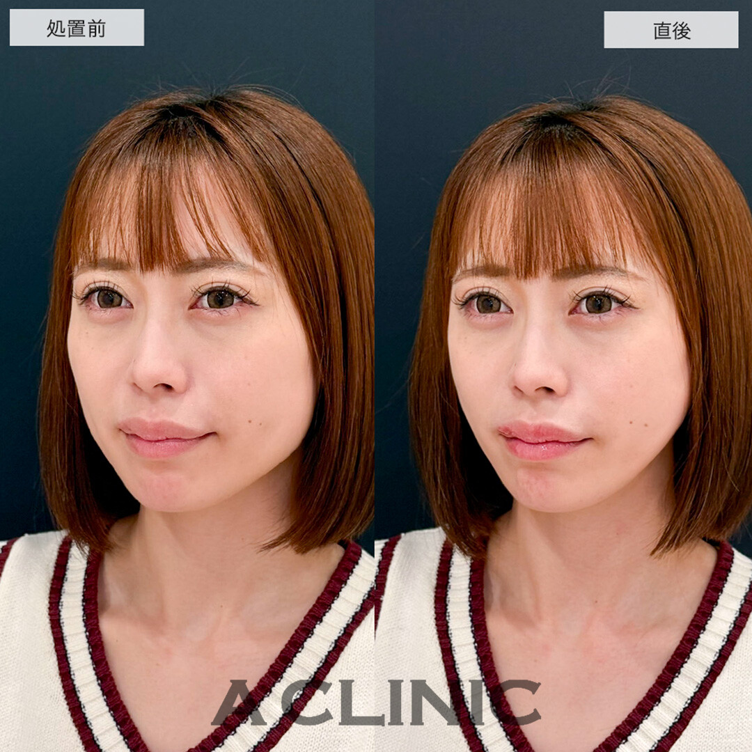 Aスレッドでたるみを引き上げて若々しい綺麗な輪郭に!こちら処置前と直後の症例です(30代女性)