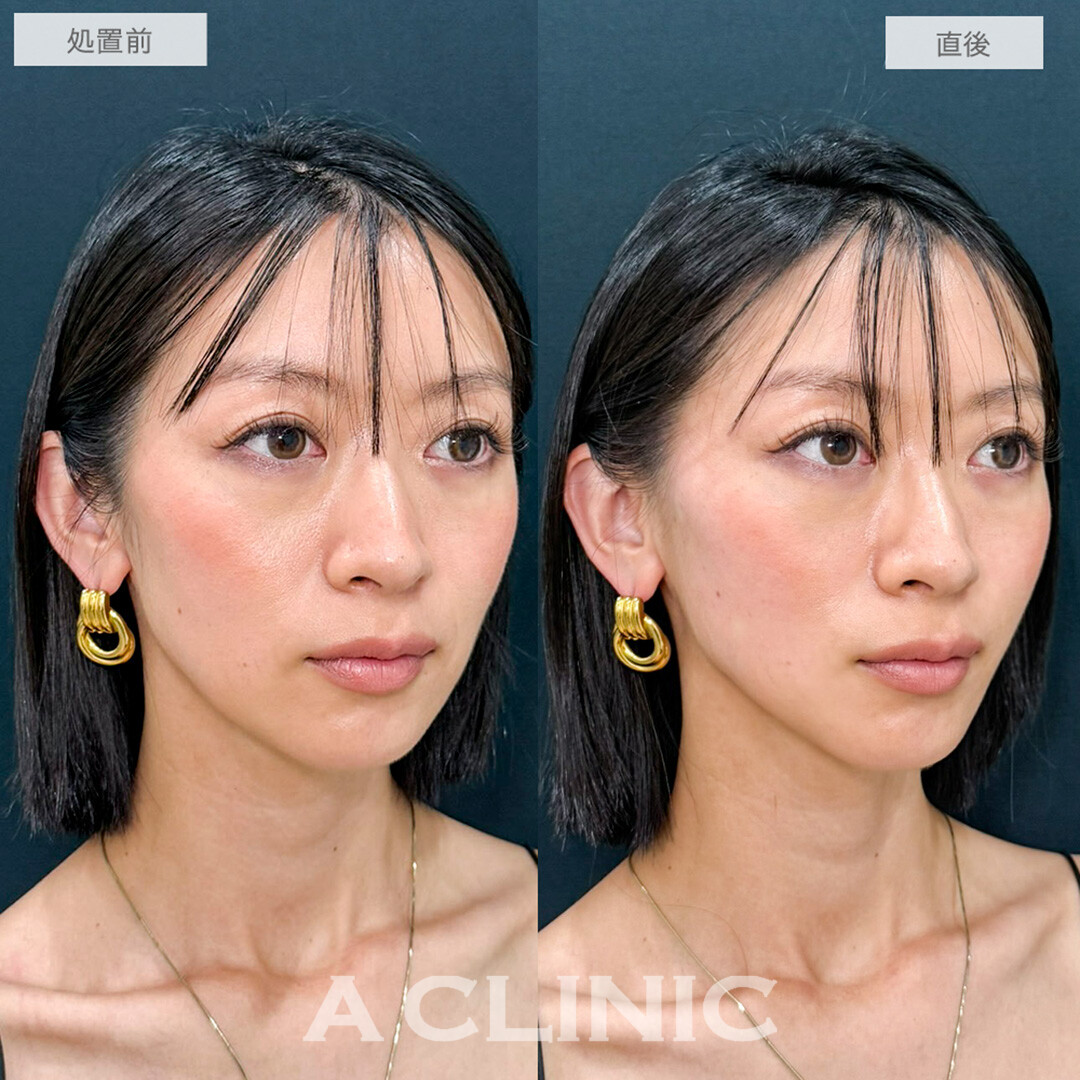 Aスレッドでほうれい線と口横のもたつき感が解消しました！処置前と直後の症例です(30代女性)