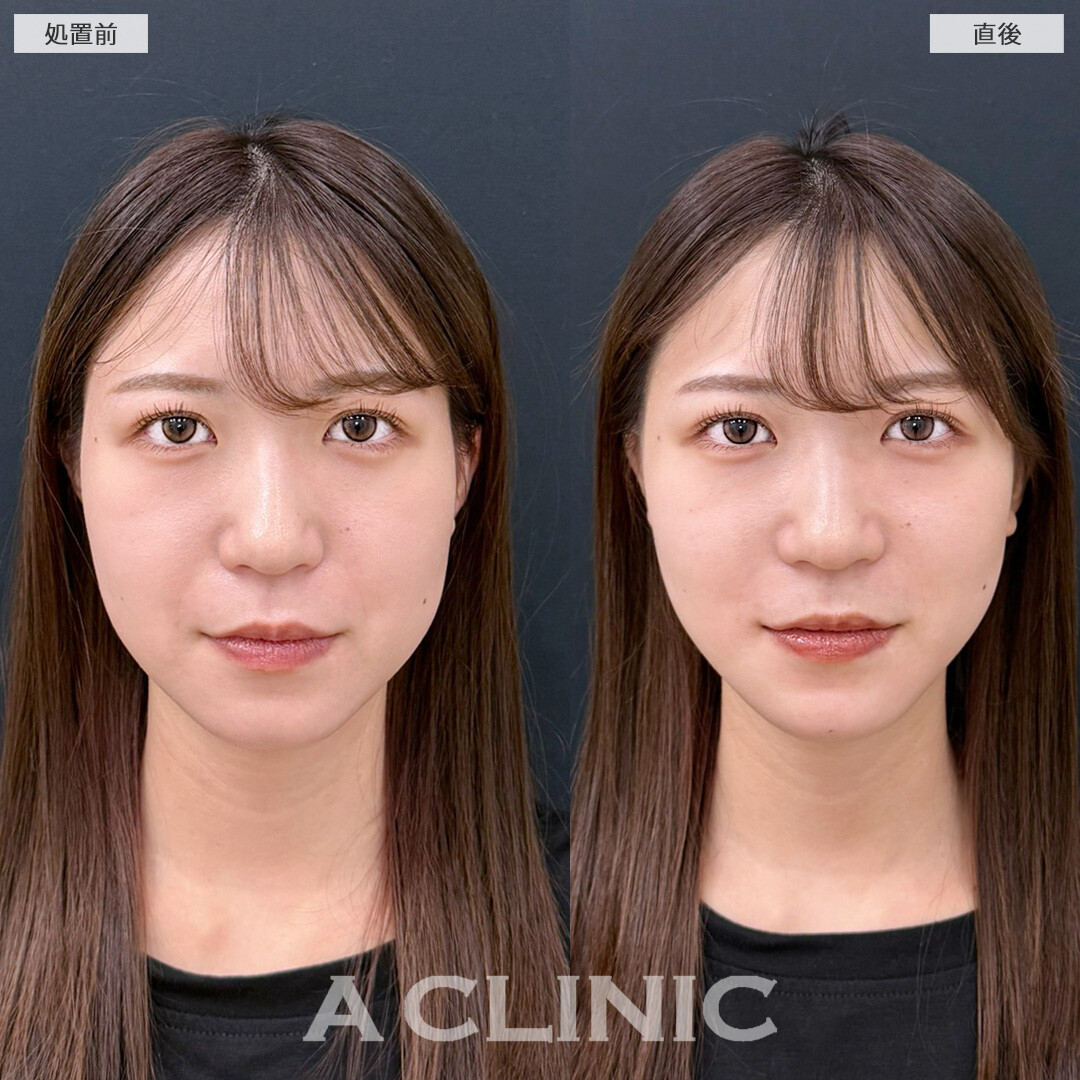 Aスレッドで直後からスッキリした輪郭になって垢抜け！こちら処置前と直後の症例です(20代女性)