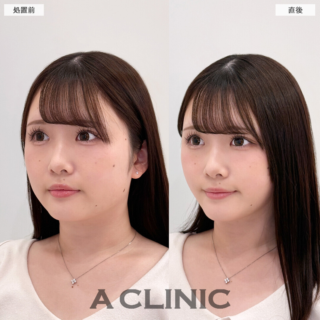Aスレッドでもたつきが改善され垢抜けました！こちら処置前と直後の症例です(20代女性)