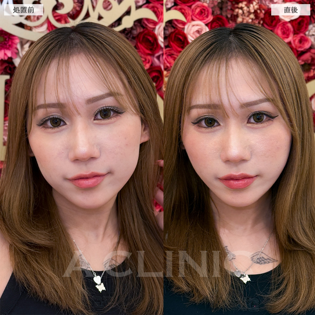 Aスレッドでホームベース型の輪郭がV字型に！処置前と直後の症例です(20代女性)