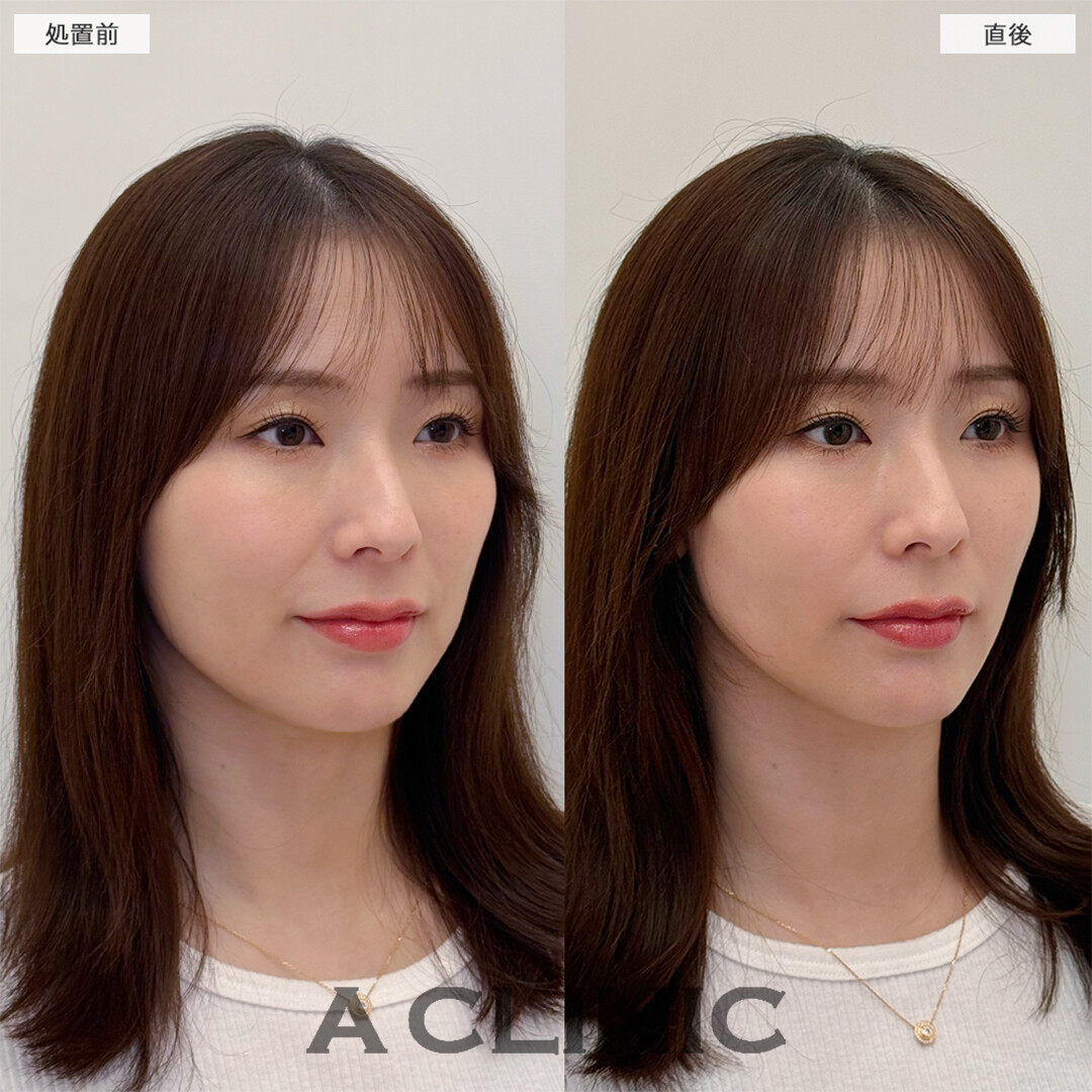 Aスレッドは老け予防でも大人気です！こちら処置前と直後の症例です(30代女性)