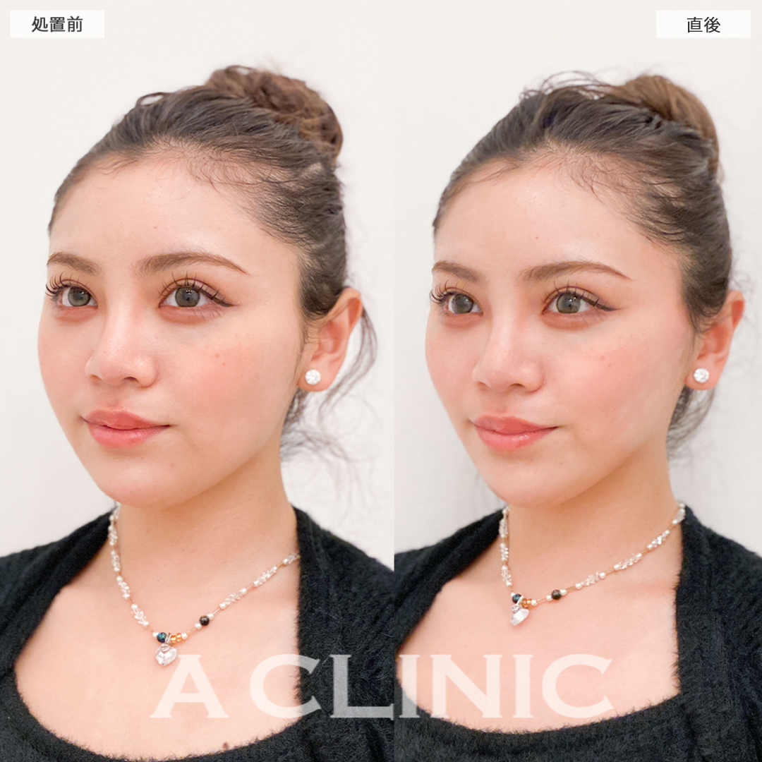 Aスレッドで韓国アイドルのような逆三角形の輪郭に大変身！こちら処置前と直後の症例です(20代女性)