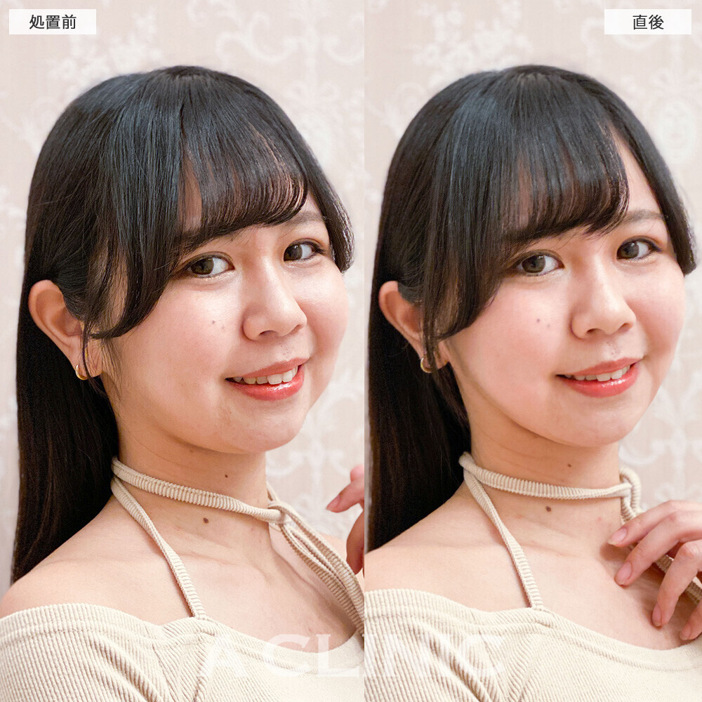 Aスレッドで頬の丸みがシュッとしました！こちら処置前と直後の症例です(20代女性)