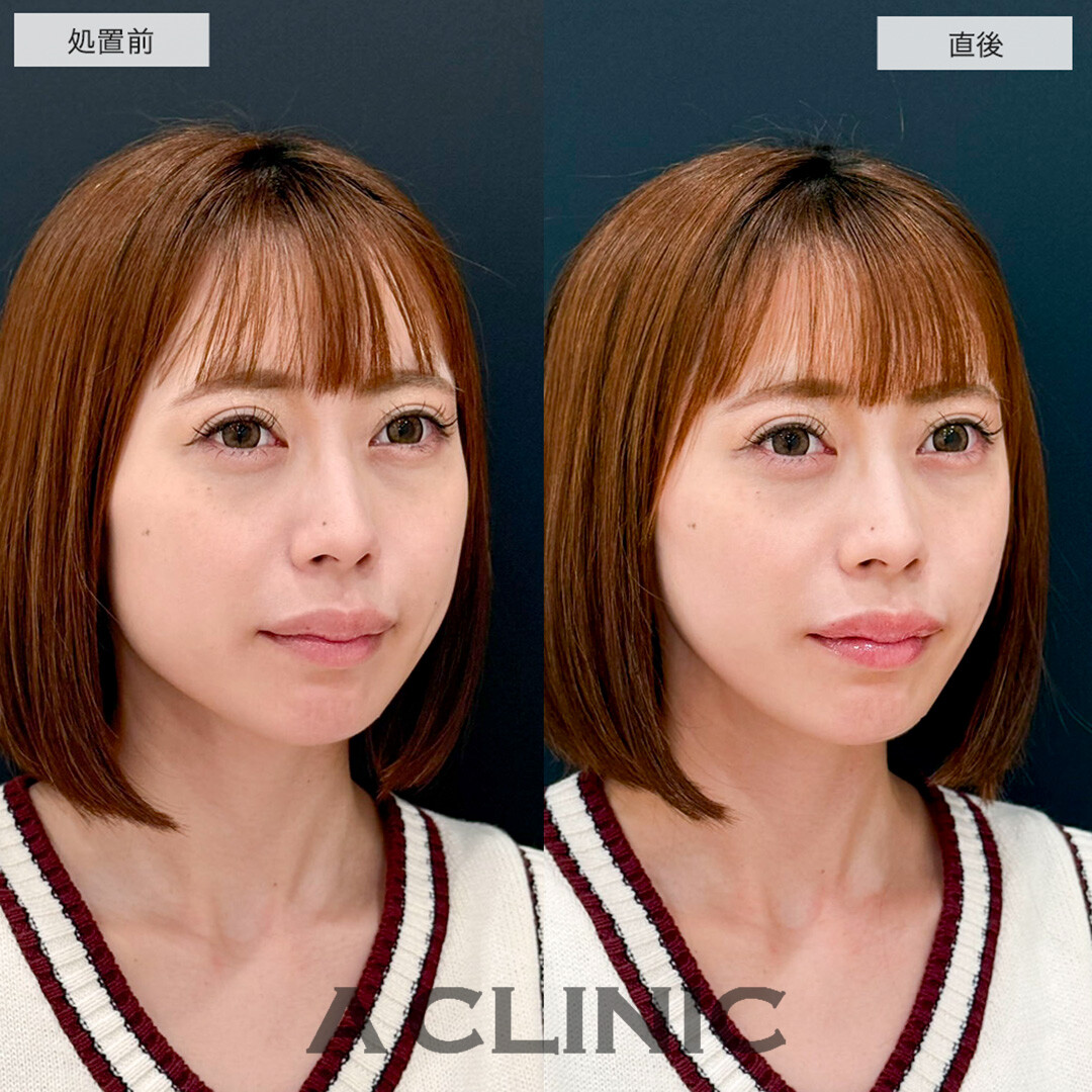 Aスレッドでたるみを引き上げて若々しい綺麗な輪郭に!こちら処置前と直後の症例です(30代女性)