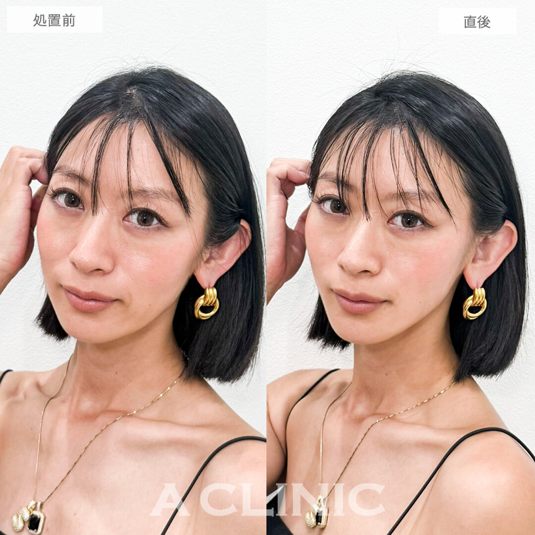 Aスレッドでほうれい線と口横のもたつき感が解消しました！処置前と直後の症例です(30代女性)