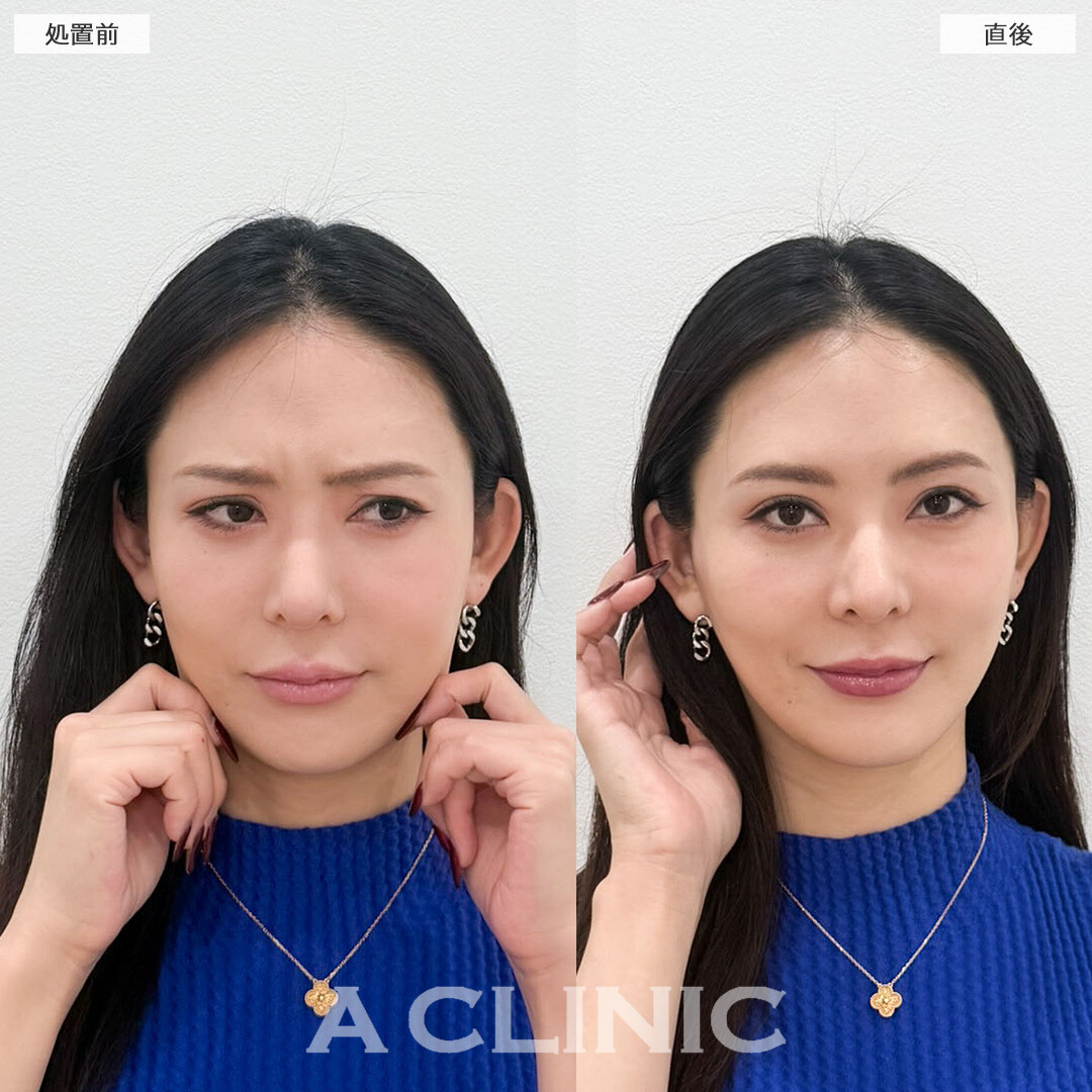 Aスレッドで左右差整えながらほうれい線も目立たなくなりました！こちら処置前と直後の症例です(40代女性)
