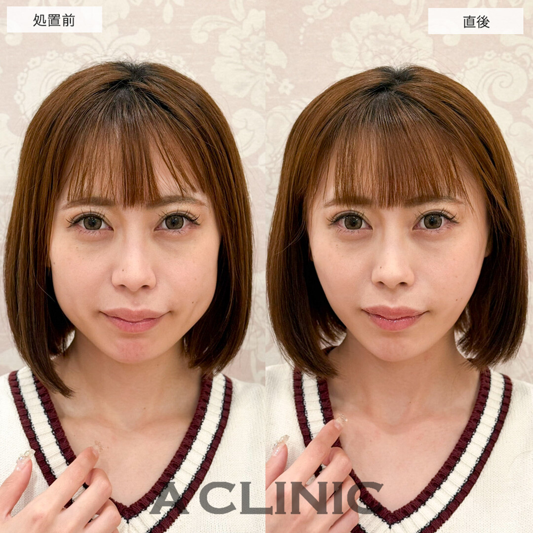 Aスレッドでたるみを引き上げて若々しい綺麗な輪郭に!こちら処置前と直後の症例です(30代女性)