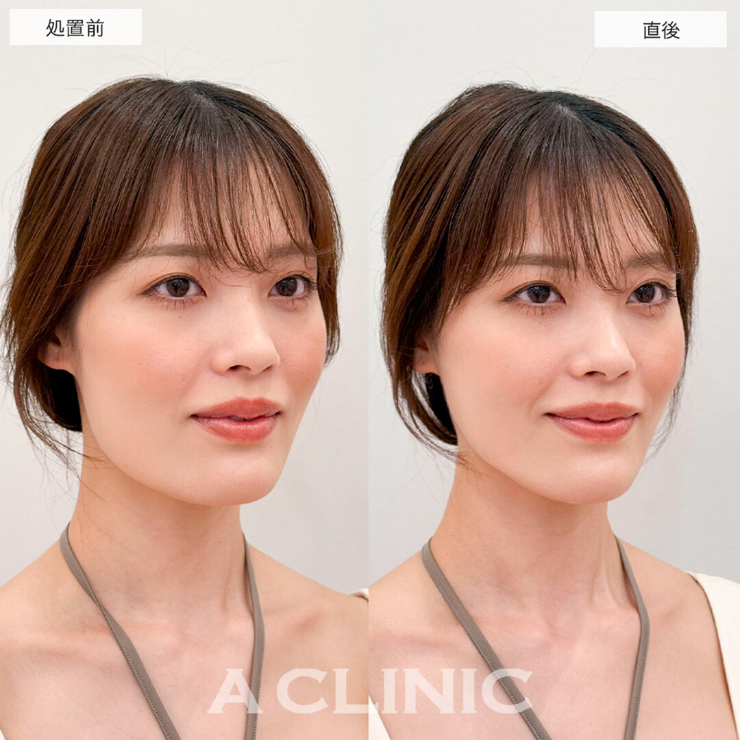 Aスレッドでたるみが改善され美しい滑らかな輪郭に!こちら処置前と直後の症例です(30代女性)