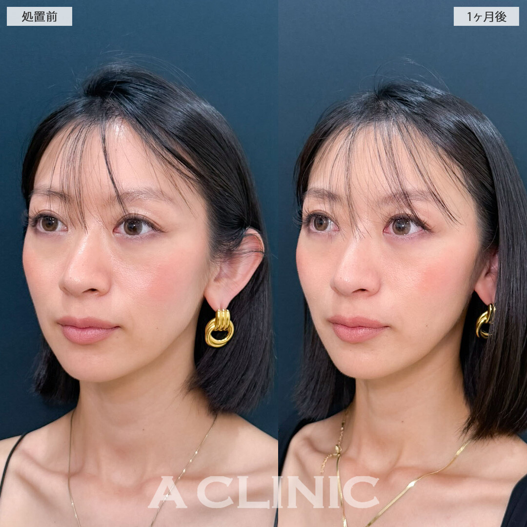 Aスレッドで輪郭を整えてさらに美しく！こちら処置前と1ヶ月後の症例です(30代女性)
